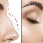 Rhinoplasty