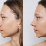 Rhinoplasty in Riyadh