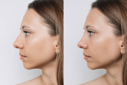 Rhinoplasty in Riyadh