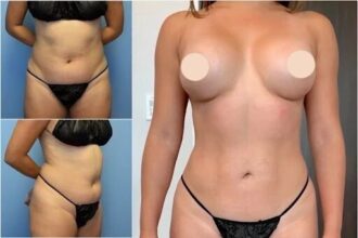 Body Contouring in dubai